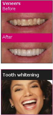 Tooth Whitening by One Complete Dental