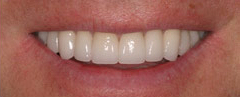 Veneers - Hartforde Dental Centre