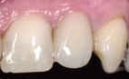 Tooth Implants - Hartforde Dental Centre